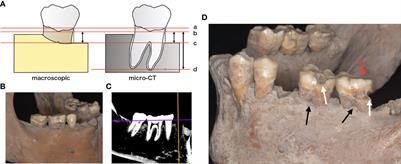 Comparison of Periodontal Bacteria of Edo and Modern Periods Using Novel Diagnostic Approach for Periodontitis With Micro-CT
